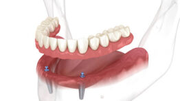 Dişsizliğe Konforlu ve Estetik Çözüm: Ball Attachment’lı Protezler ile Güçlü Gülüşler Mümkün