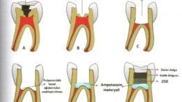 Süt Dişi Amputasyonu: Derin Çürüklerde Dişi Kurtarma Yöntemi Giderek Yaygınlaşıyor