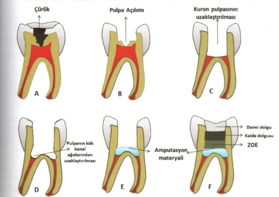  Süt Dişi Amputasyonu: Derin Çürüklerde Dişi Kurtarma Yöntemi Giderek Yaygınlaşıyor