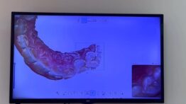 Diş Hekimliğinde Dijital Dönüşüm: Konforlu ve Hızlı Tedavi Dönemi Başladı