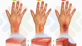 “Her Şeyden Önce Sağlık”ta Orman Yangınları ve Yanıklar Masaya Yatırıldı