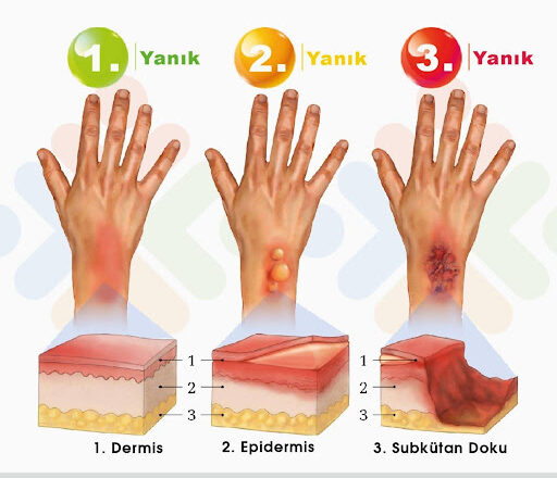  “Her Şeyden Önce Sağlık”ta Orman Yangınları ve Yanıklar Masaya Yatırıldı